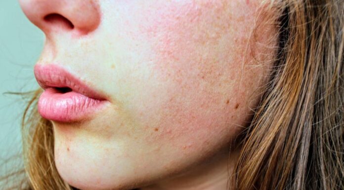 Sådan forebygger du kløe i tør hud